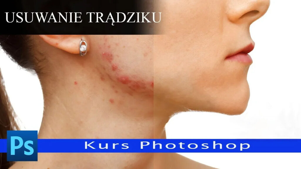 Retusz twarzy. Usuwanie trądziku - kurs photoshop